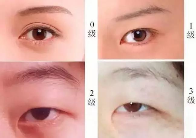 中国人小眼睛为什么这么多? 如何才能拥有大眼睛?