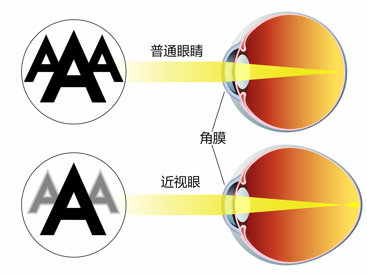 眼睛近视了怎么恢复？|视网膜|接触镜|恢复|近视|角膜|矫正|手术|-健康界